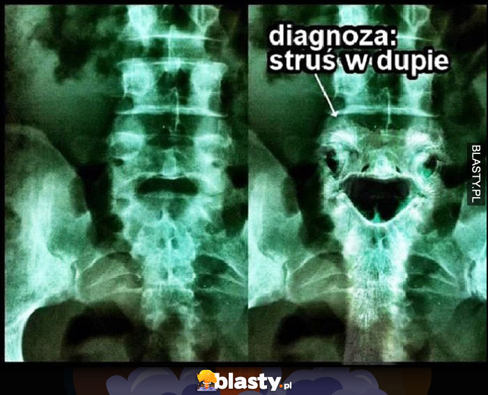 Prześwietlenie diagnoza struś w dupie