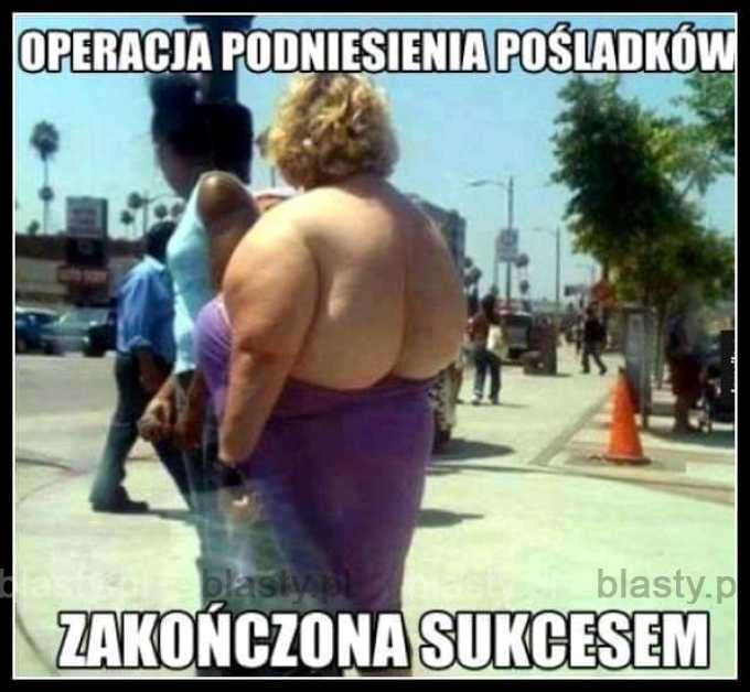 Operacja podniesienia pośladków zakończona sukcesem